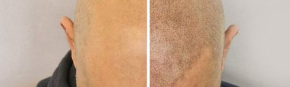 Scalp Micropigmentation – Look 10 years younger in just a few hours!